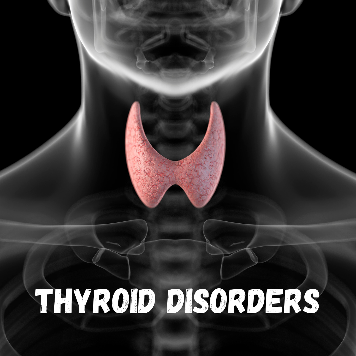thyroid disorders - thyroditis